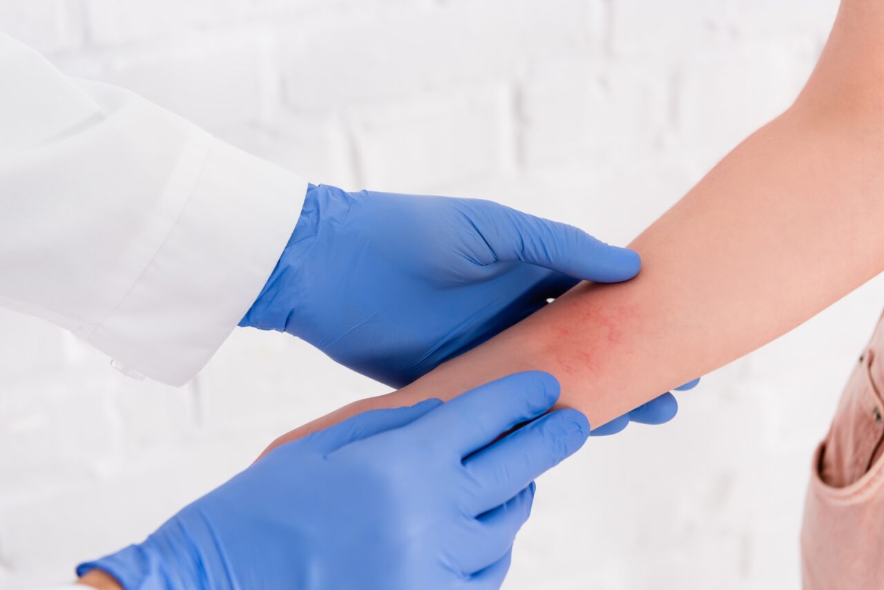 Cropped view of doctor inspecting arm of woman with allergy